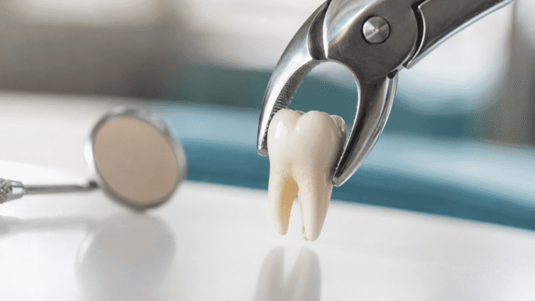 Tooth Extraction Cost in San Antonio